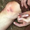 Consequences of the final fall:  a small cut and a big bruise